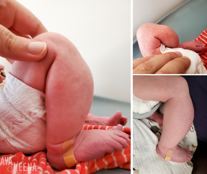 baby caffey disease