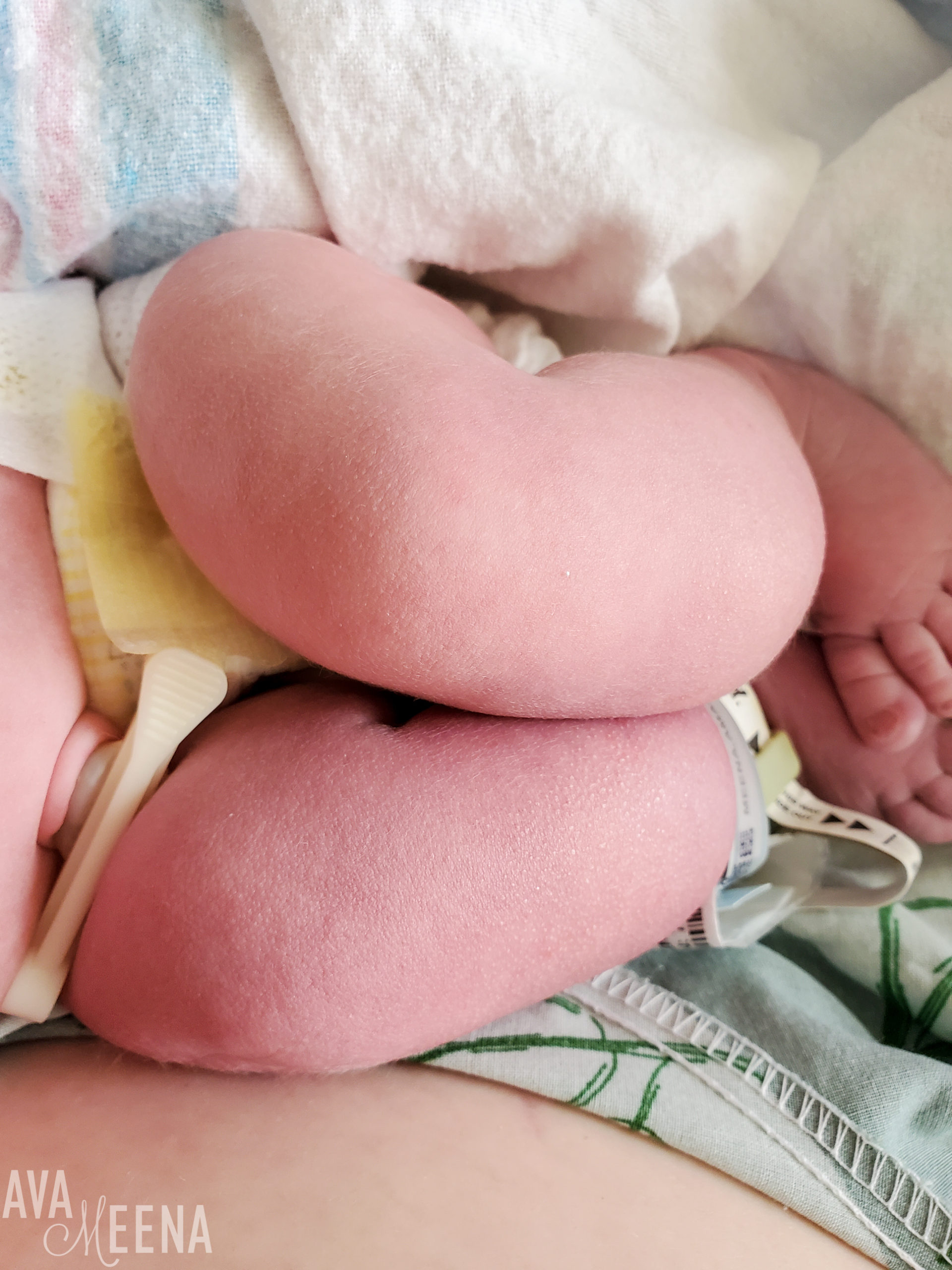 caffey disease at birth in legs
